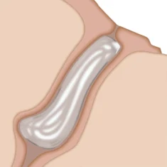 FORM FIT® Hydrożelowe zatyczki kanałowe