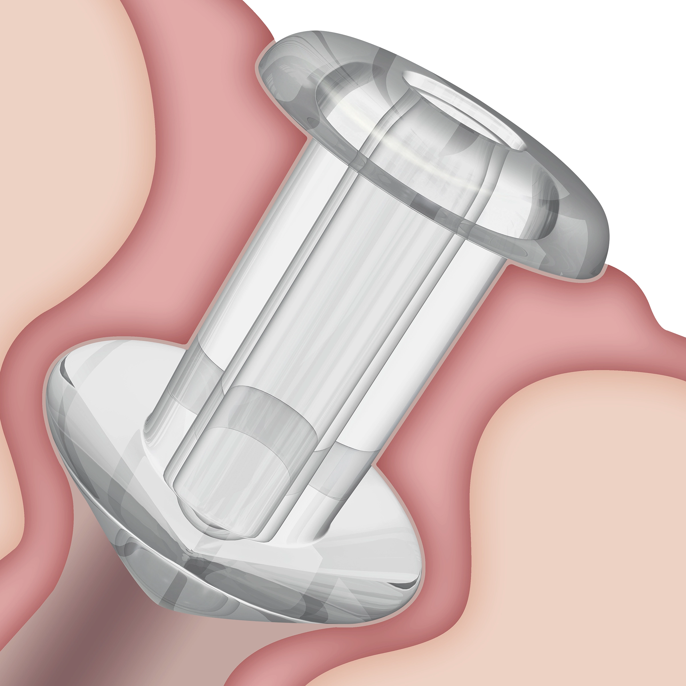 SOFT PLUG® Flow Control Zatyczki silikonowe