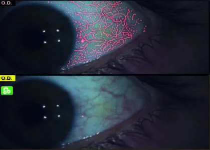 Automatyczne badanie NIBUT