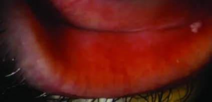 Automatyczne badanie NIBUT