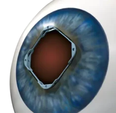 Pierścień rozszerzający Iris Expander®