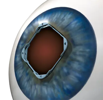 Pierścień rozszerzający Iris Expander®